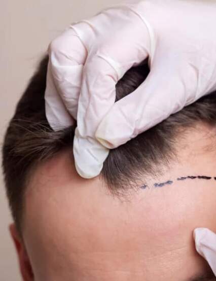 http://www.phoenixcosmeticcentre.com/hair-transplant-surgery